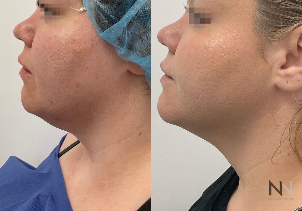 Chin Liposuction - Thumbnail 3