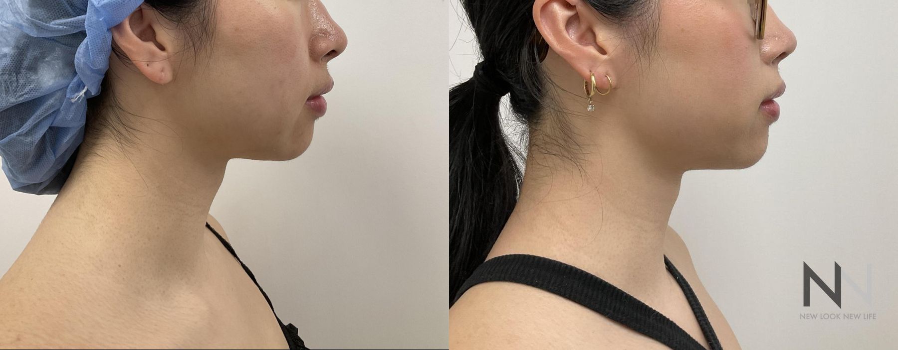 Before and after chin liposuction four months results - Angle 5