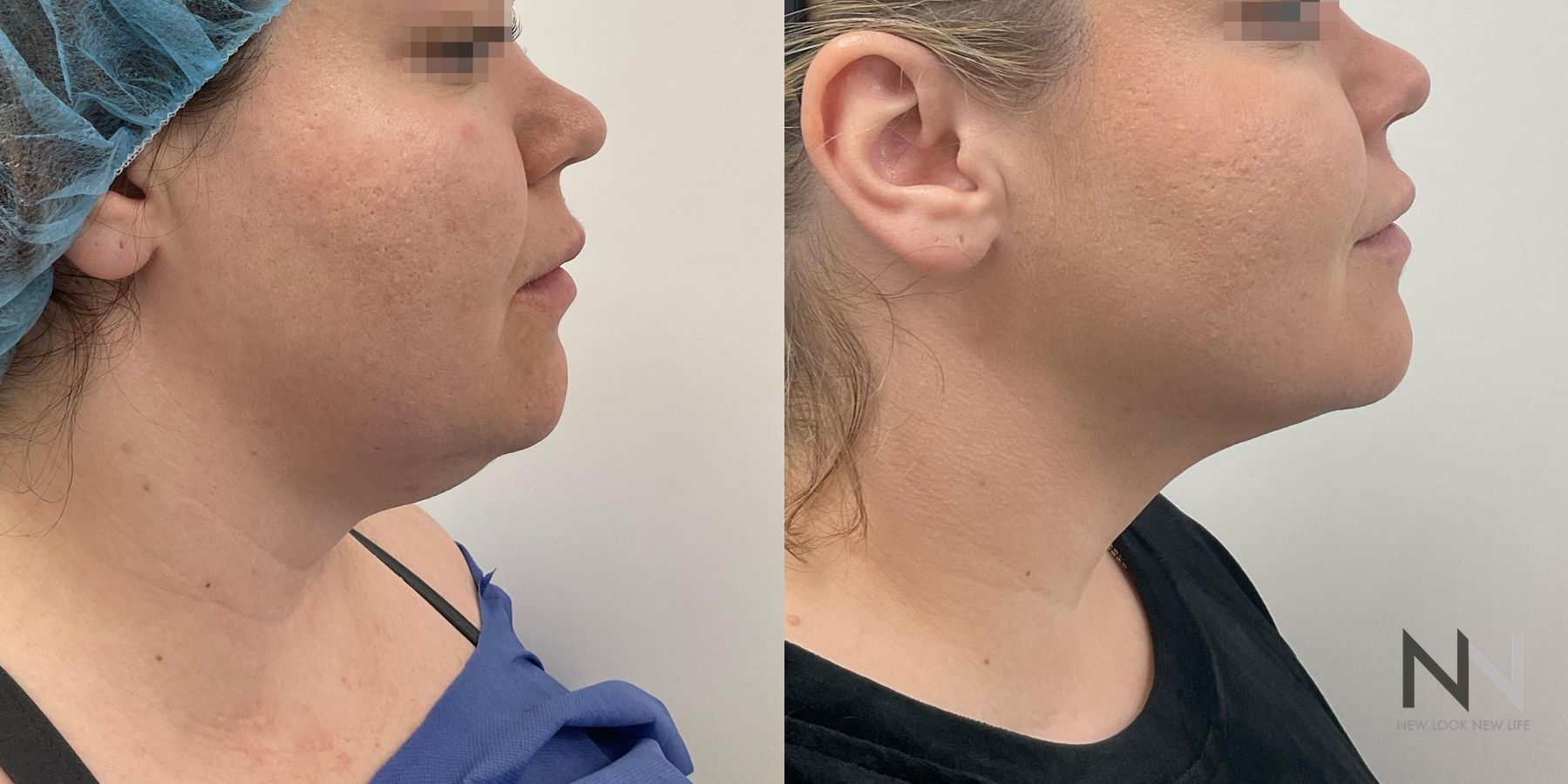 Before and after chin liposuction four months results
