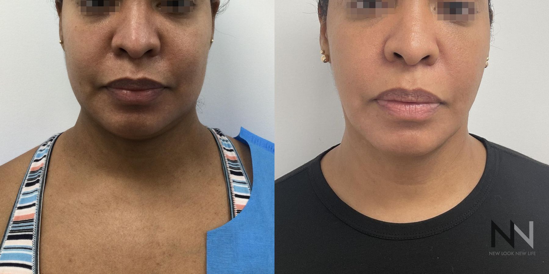 Submental liposuction showing improved jawline contour - Angle 3