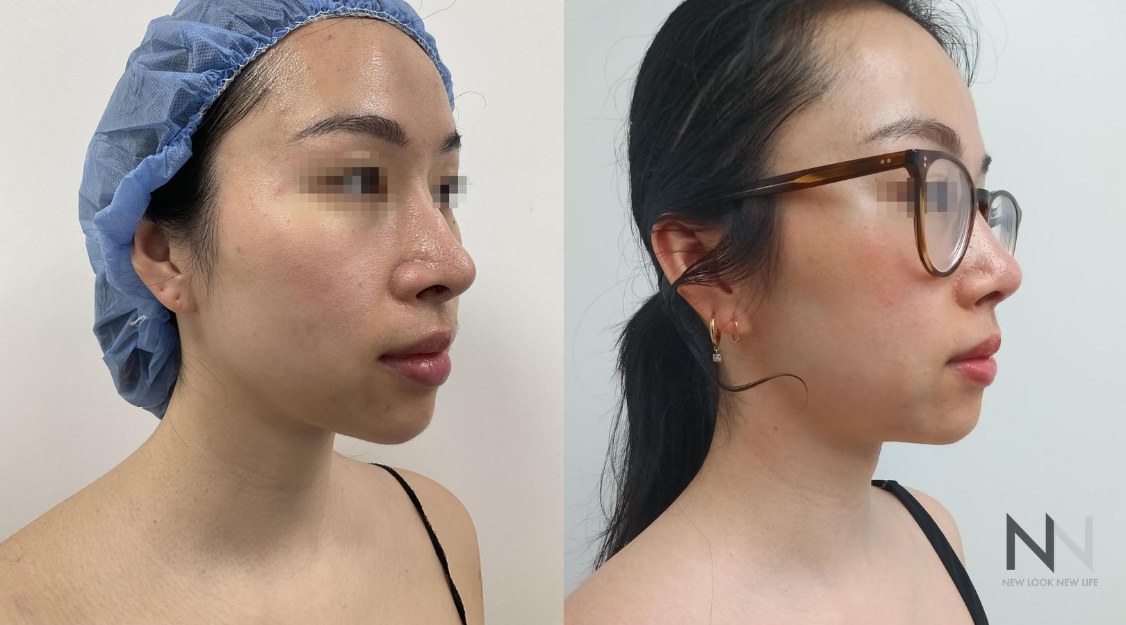 Before and after chin liposuction four months results - Angle 4