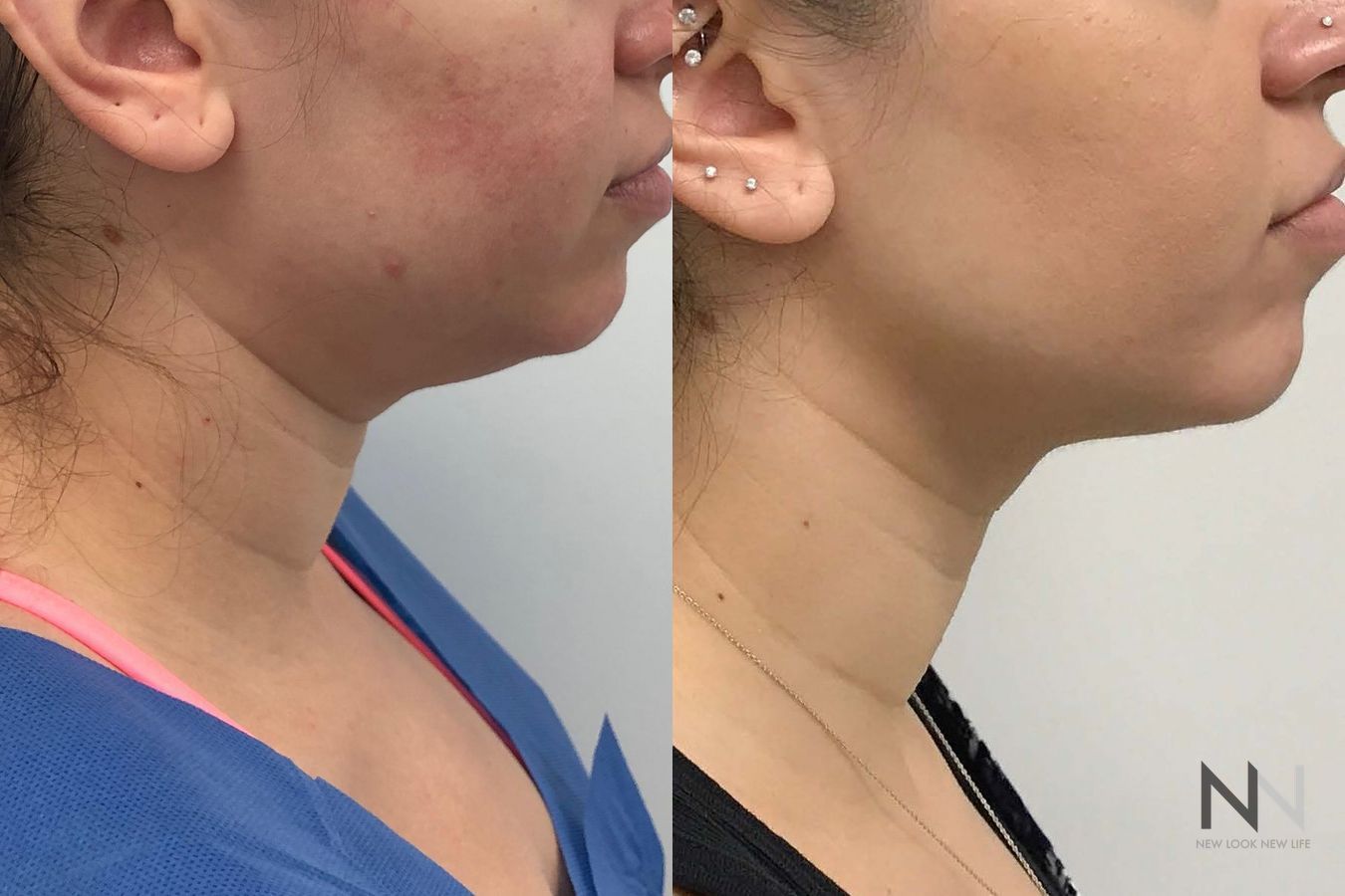 Submental liposuction showing improved jawline contour - Angle 3