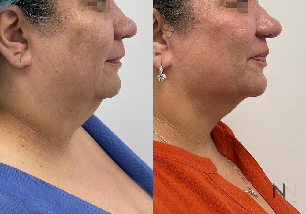 Chin Liposuction - Case 2154