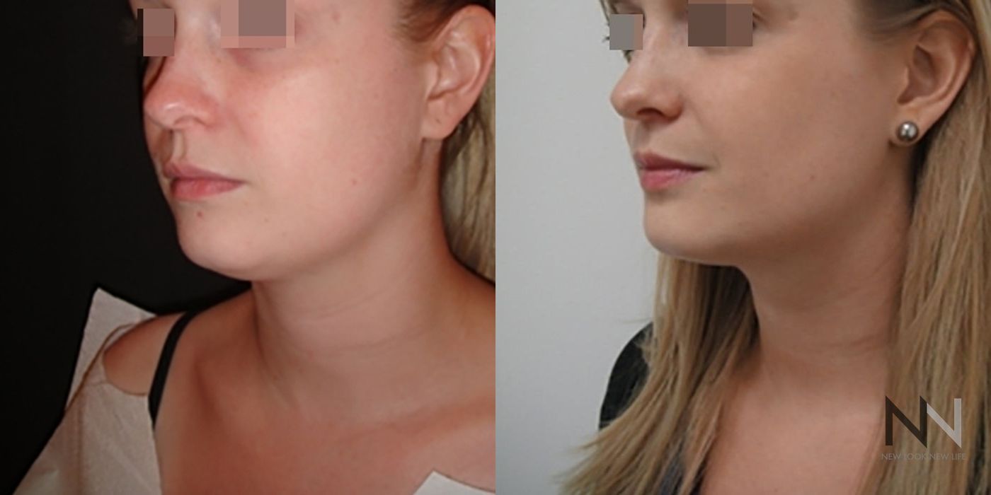 Chin Liposuction - Thumbnail 2