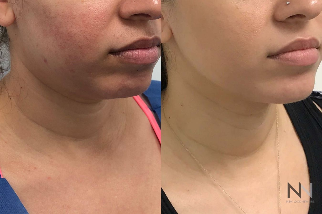 Submental liposuction showing improved jawline contour - Angle 2