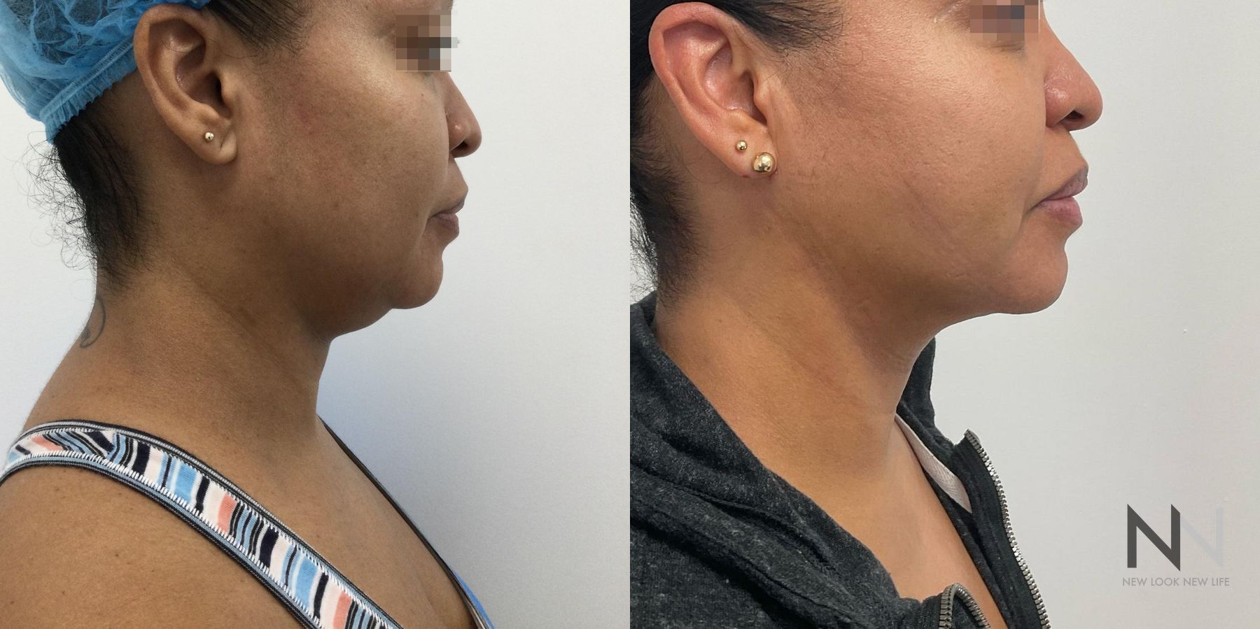 Submental liposuction showing improved jawline contour
