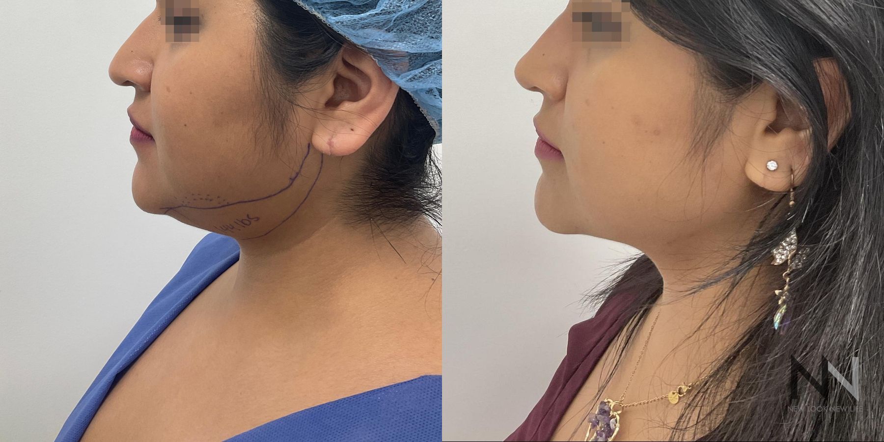 Submental liposuction showing improved jawline contour - Angle 2