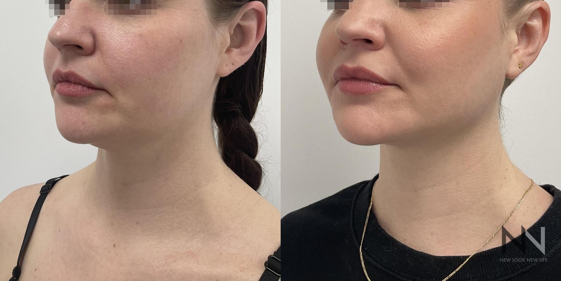 Submental liposuction showing improved jawline contour - Angle 2