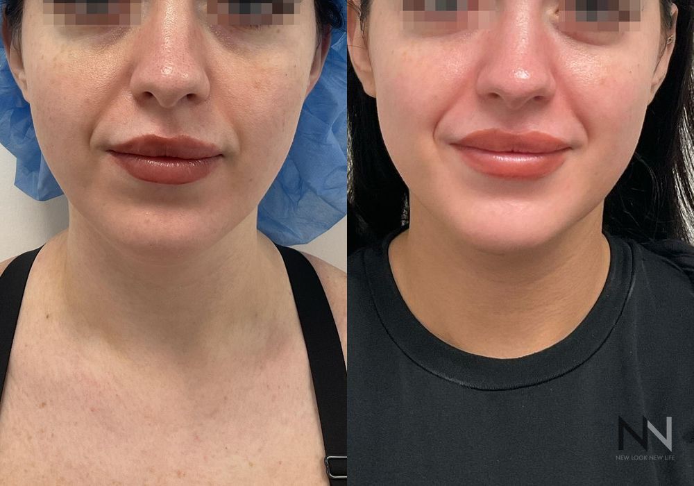 Chin Liposuction - Case 2147