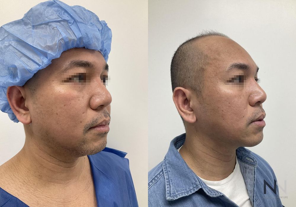 Chin Liposuction - Case 1627