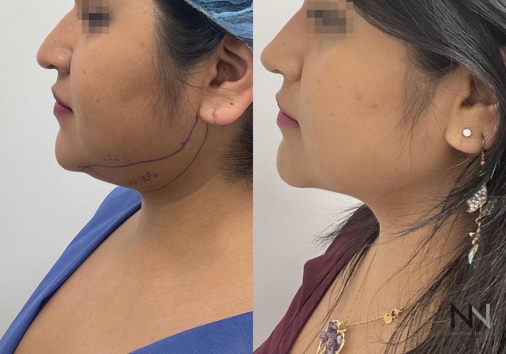 Chin Liposuction - Thumbnail 3