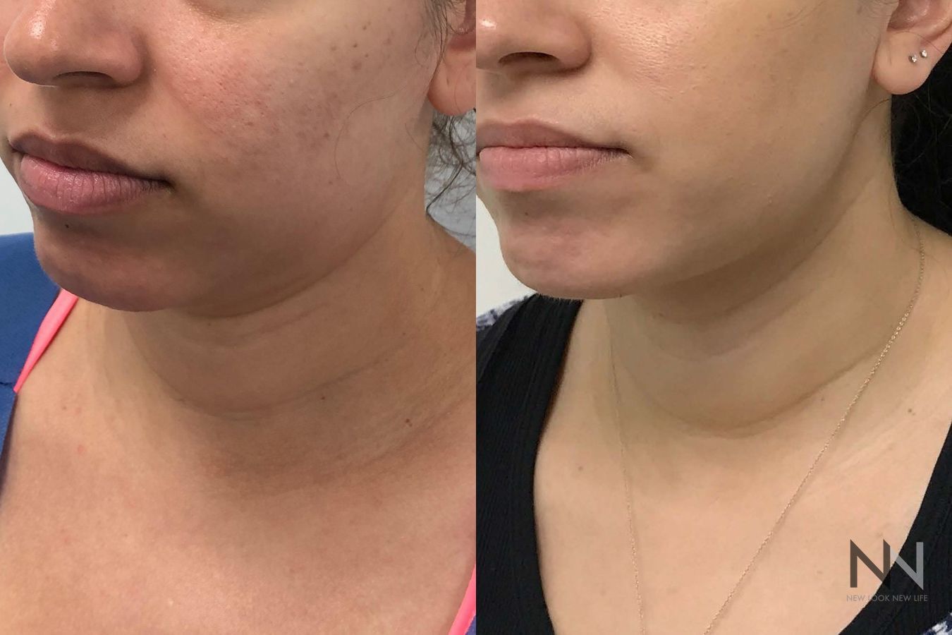 Submental liposuction showing improved jawline contour - Angle 4