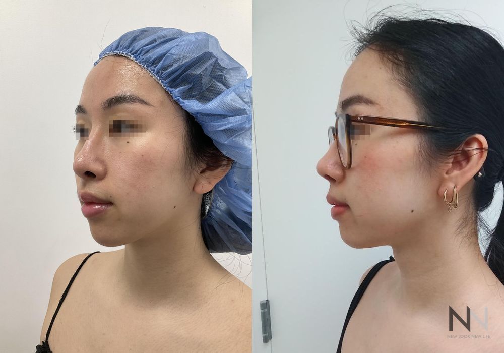 Chin Liposuction - Thumbnail 2