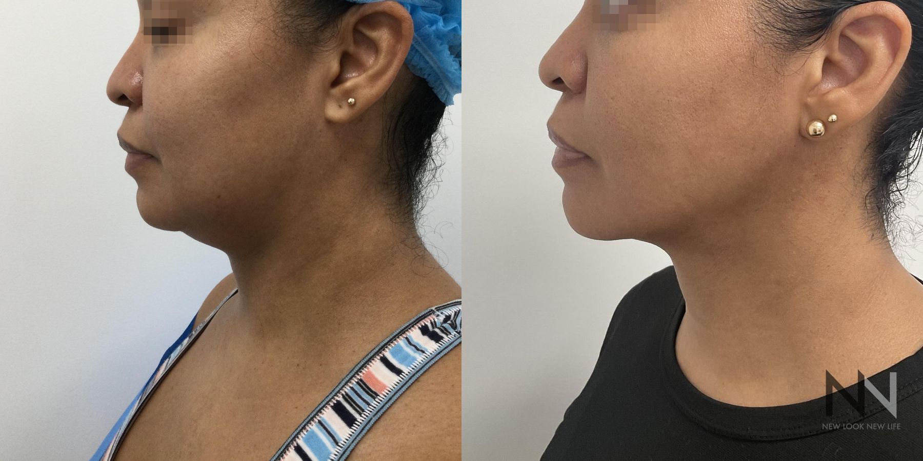 Submental liposuction showing improved jawline contour - Angle 2