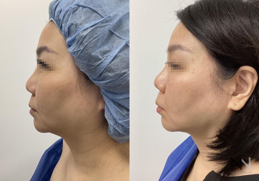 Chin Liposuction - Thumbnail 3