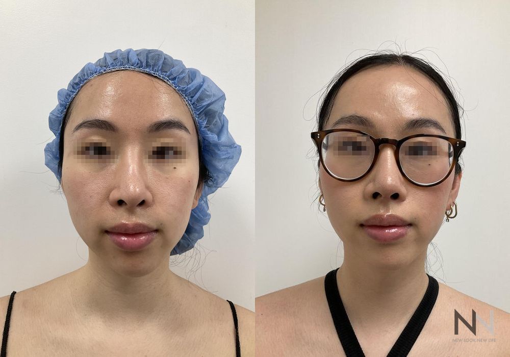 Chin Liposuction - Case 2158