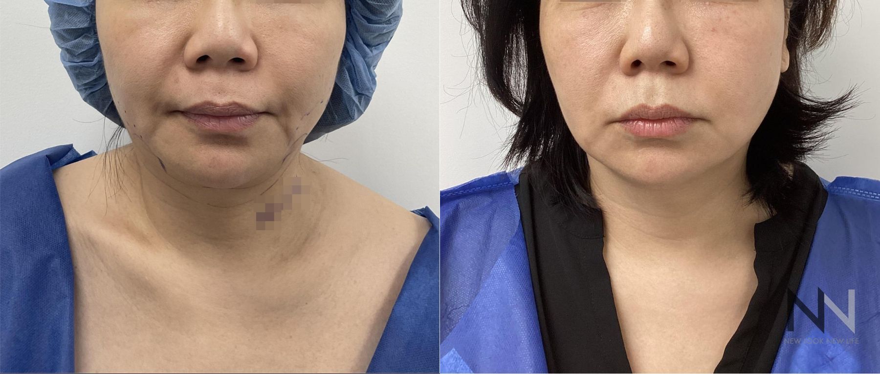 Before and after chin liposuction four months results - Angle 3