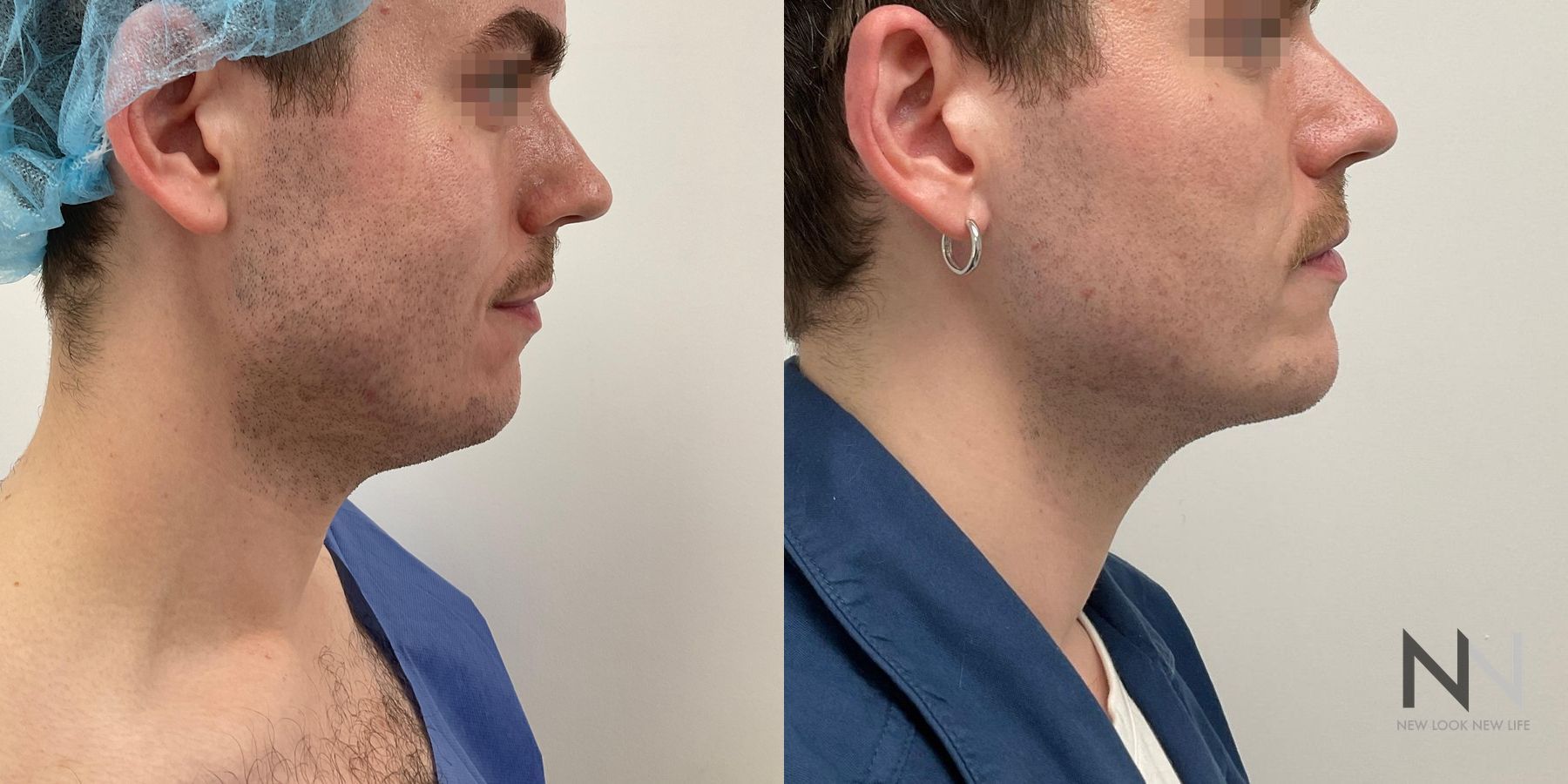 Submental liposuction showing improved jawline contour - Angle 2