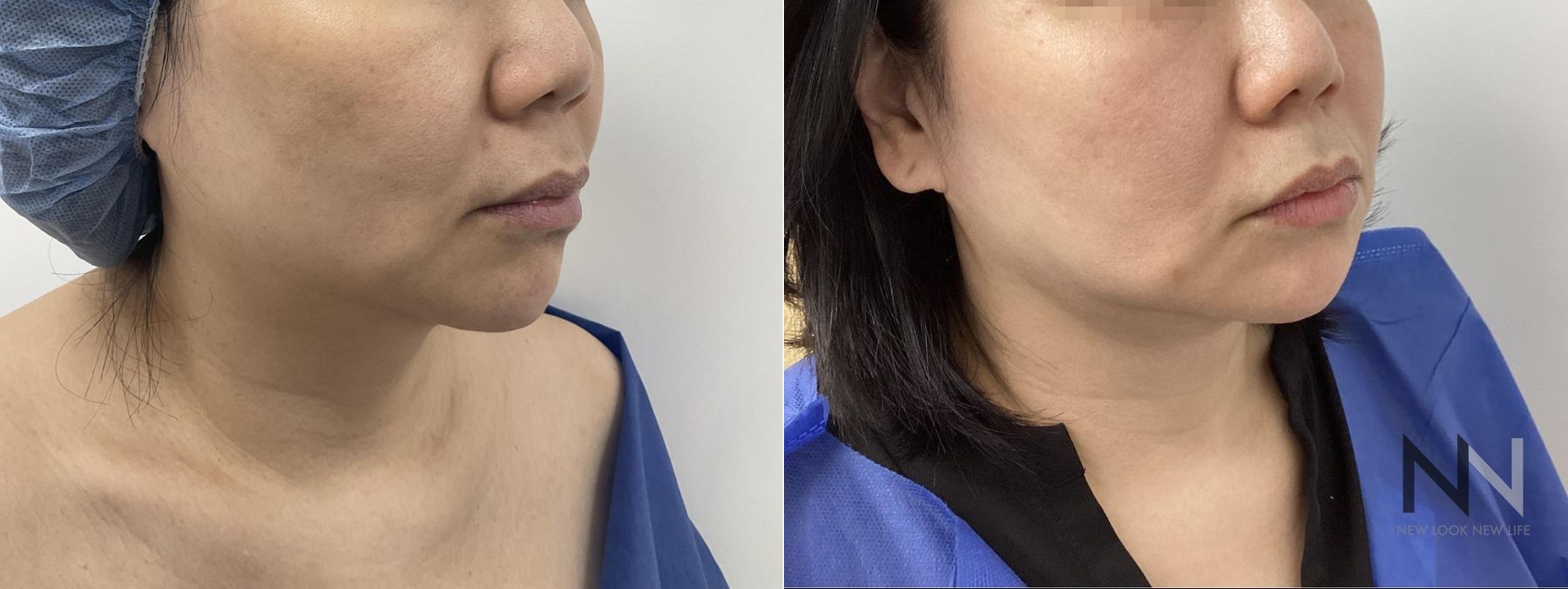 Before and after chin liposuction four months results - Angle 4