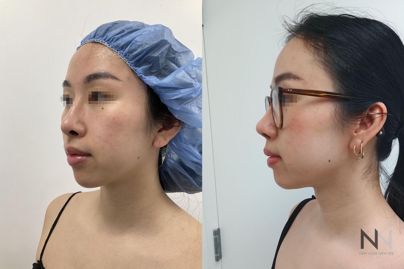 Before and after chin liposuction four months results - Angle 2