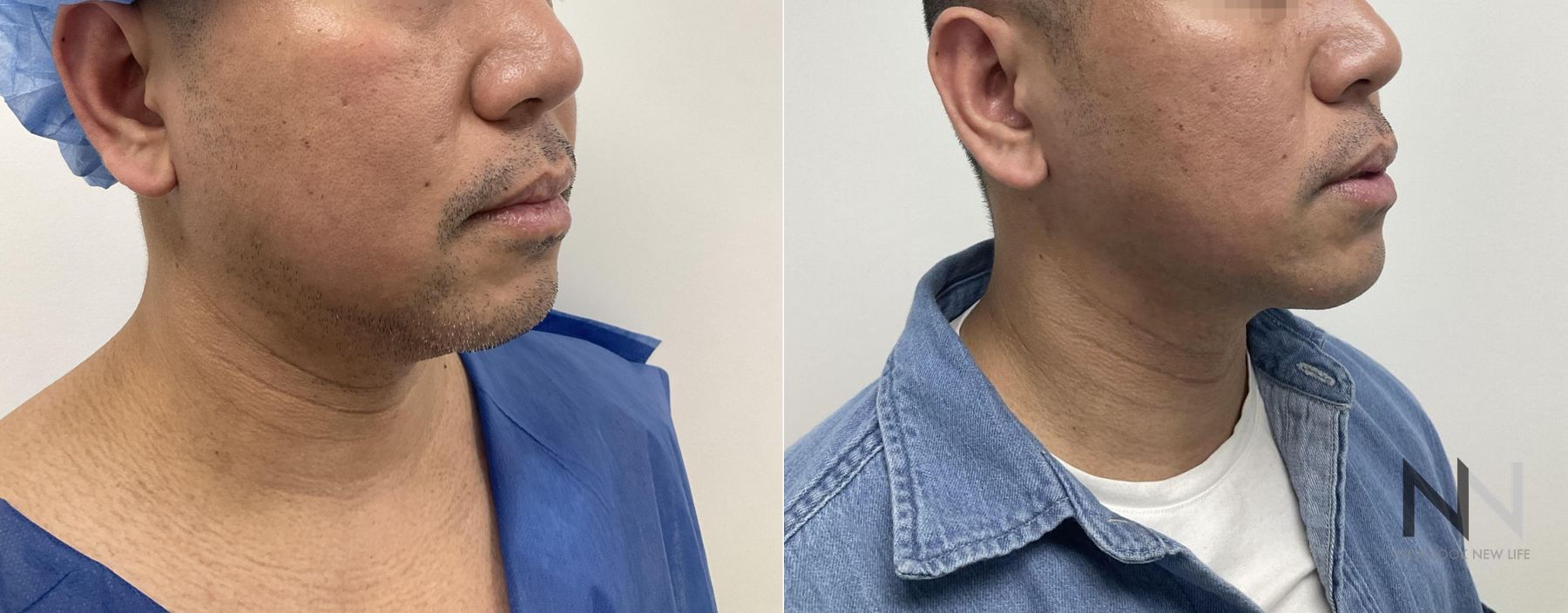 Submental liposuction showing improved jawline contour - Angle 4