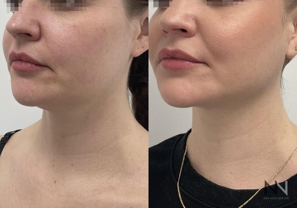 Chin Liposuction - Thumbnail 2