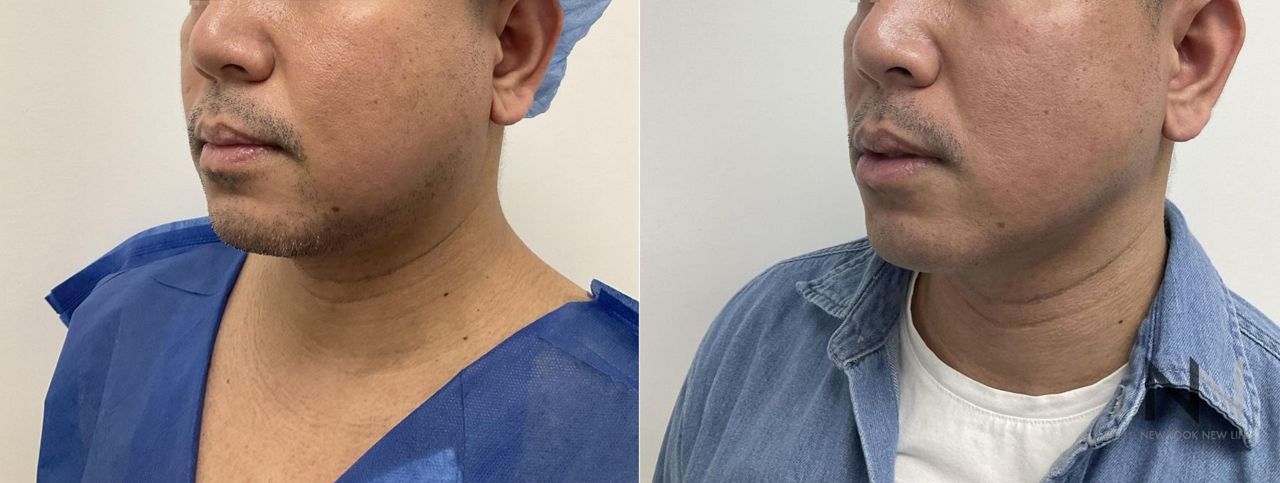 Submental liposuction showing improved jawline contour - Angle 2