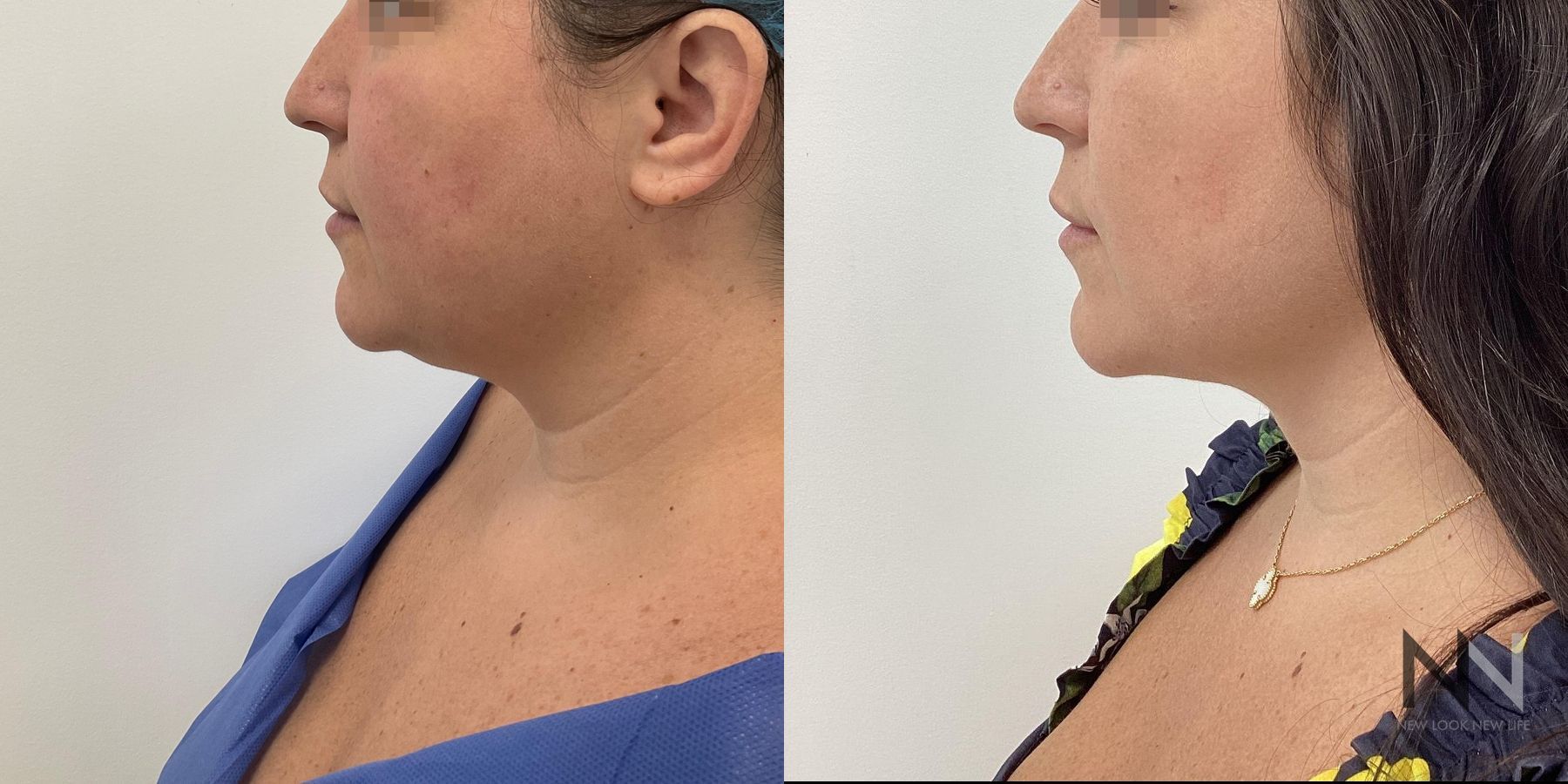 Chin liposuction before and after side profile comparison