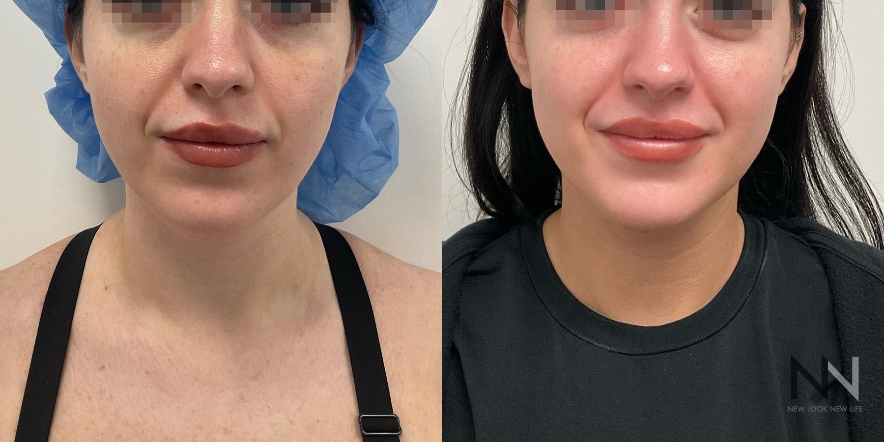 Submental liposuction showing improved jawline contour - Angle 4