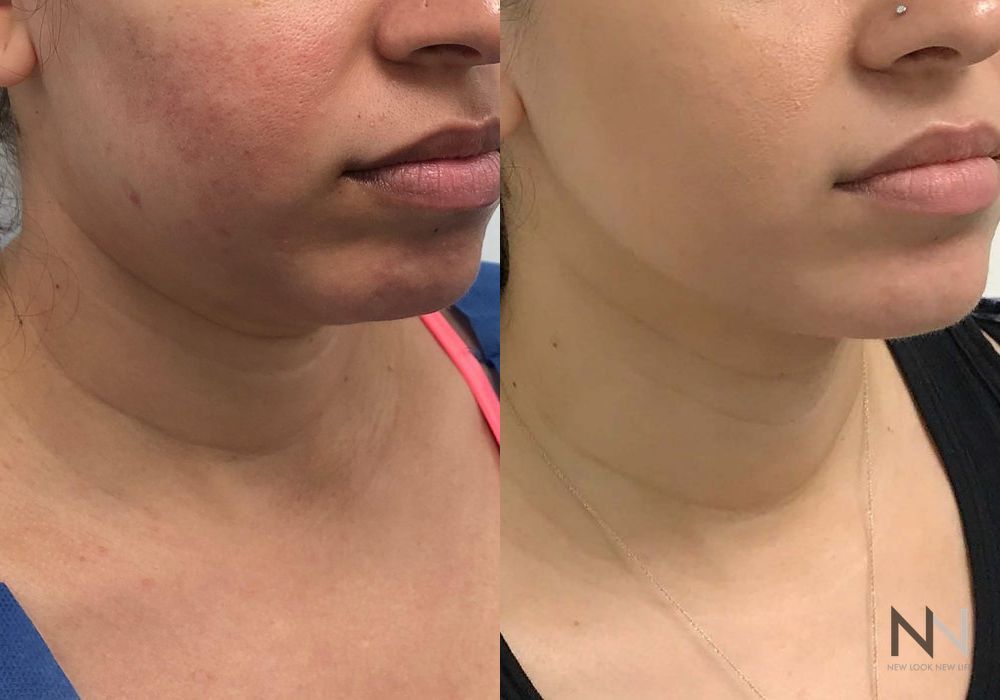 Chin Liposuction - Thumbnail 2