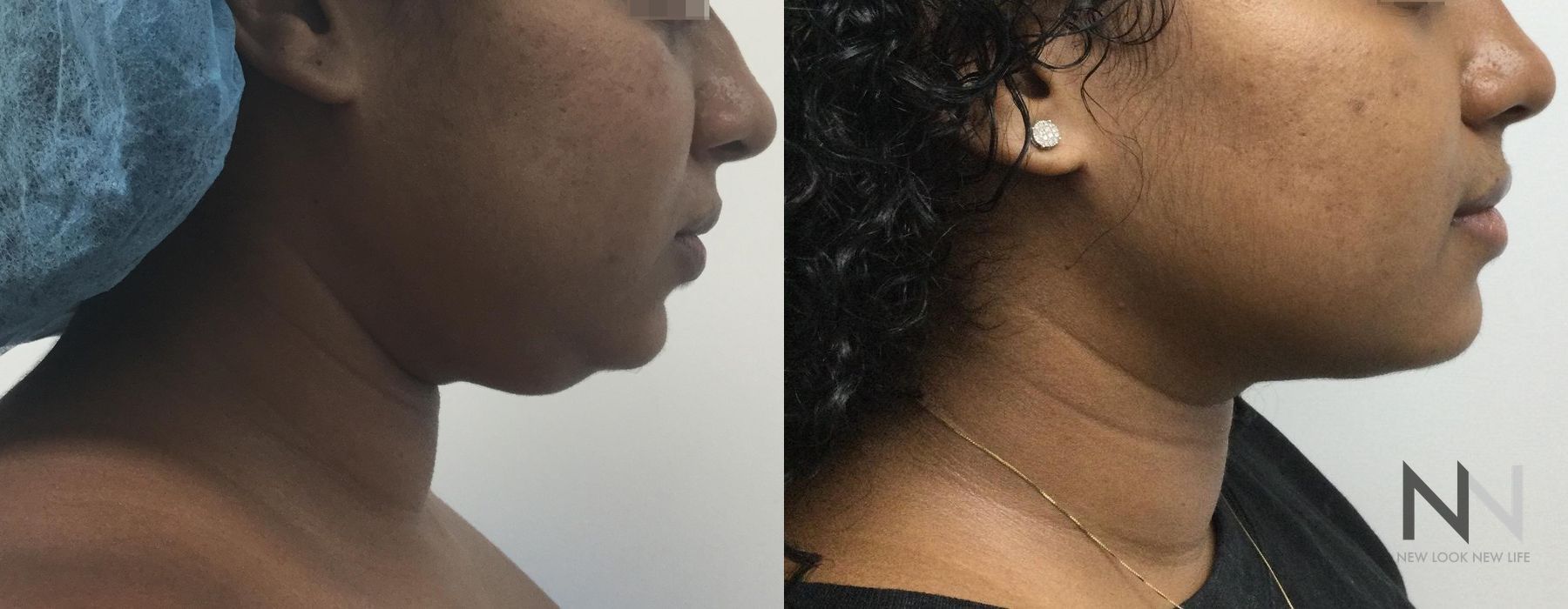 Chin Liposuction - Case 199