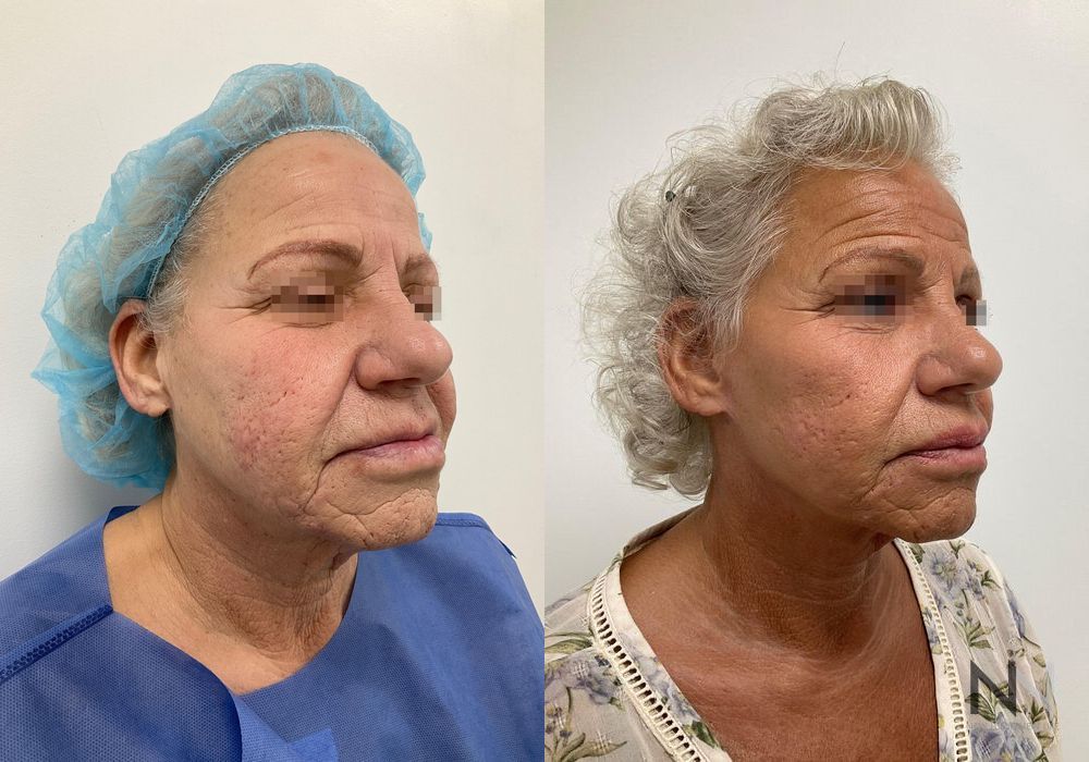 Facelift - Case 1641