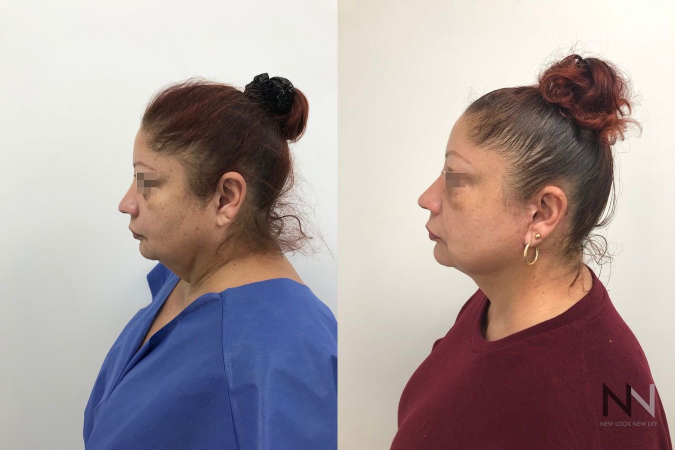 Before and after mini facelift with fat grafting and Halo laser - Angle 3
