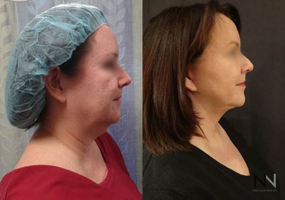 Facelift - Case 1635