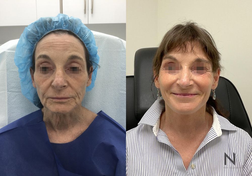 Facelift - Case 1630