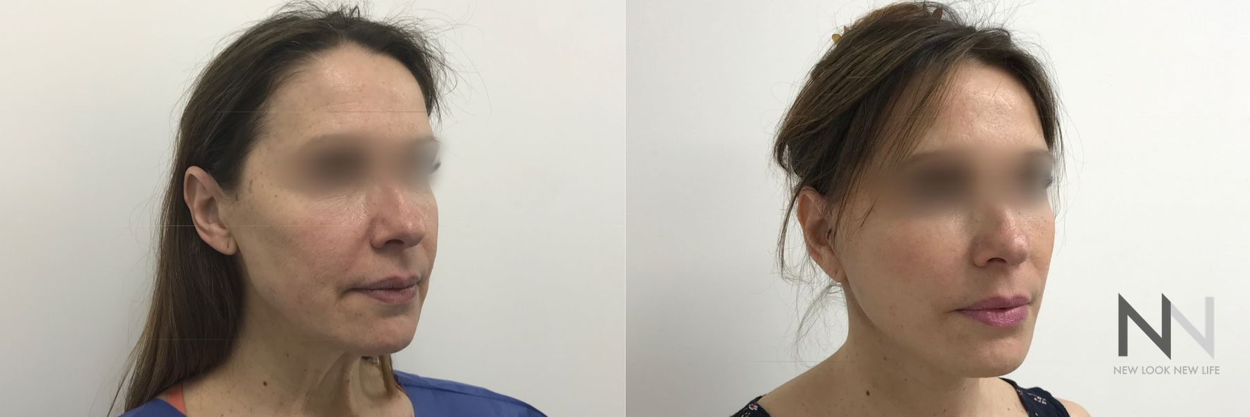 Before and after facelift with fat grafting results - Angle 2
