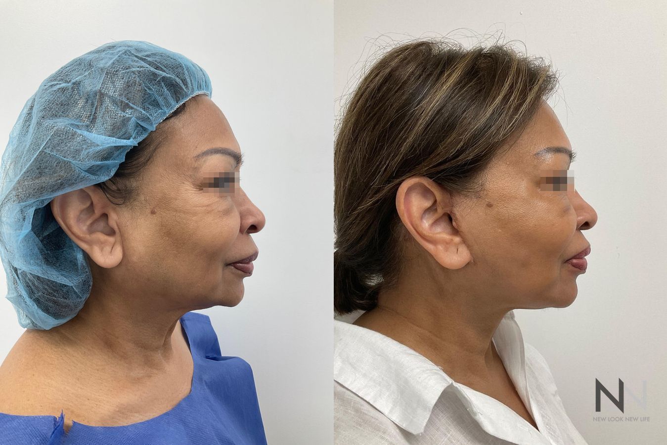 Neck lift before and after comparison frontal view - Angle 3