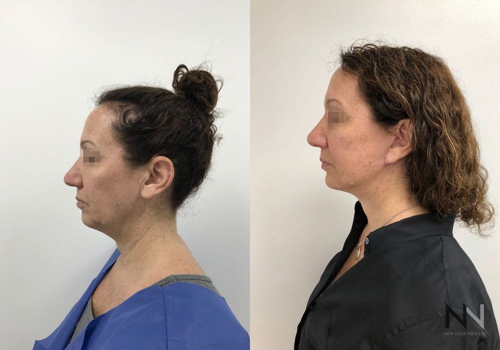 Facelift - Thumbnail 3