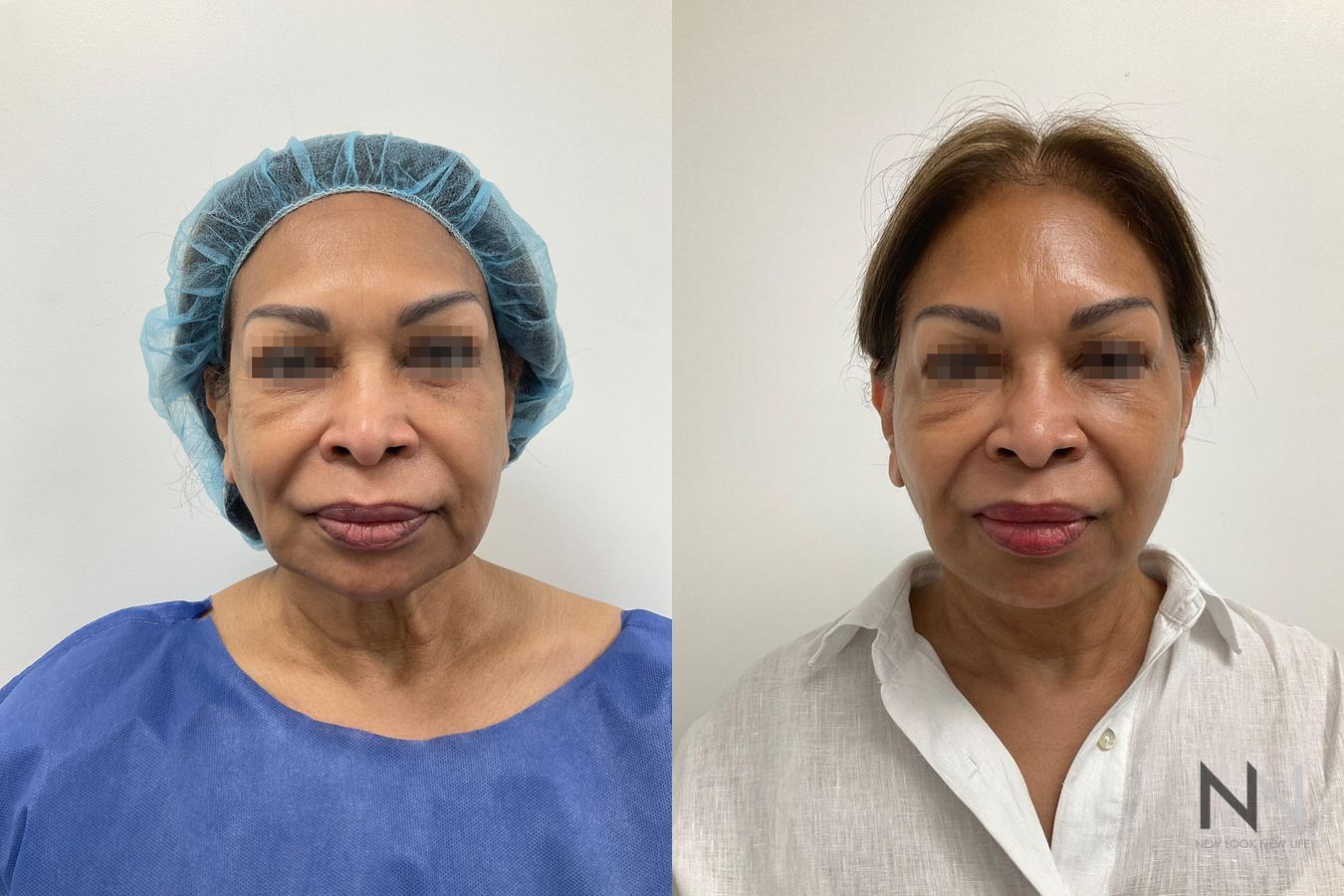 Neck lift before and after comparison frontal view