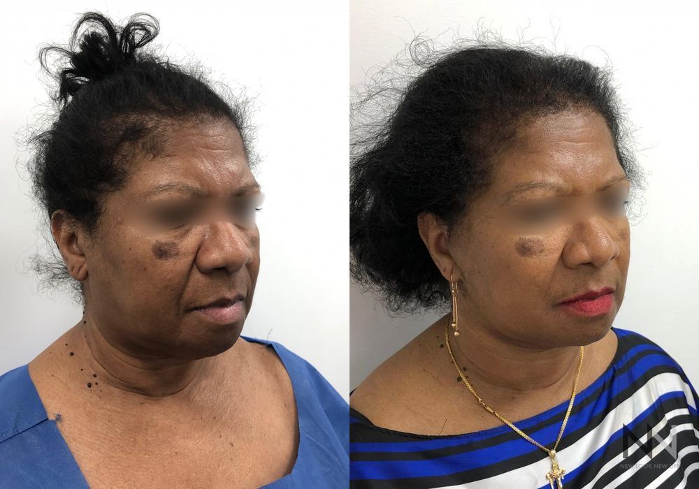 Facelift - Thumbnail 4