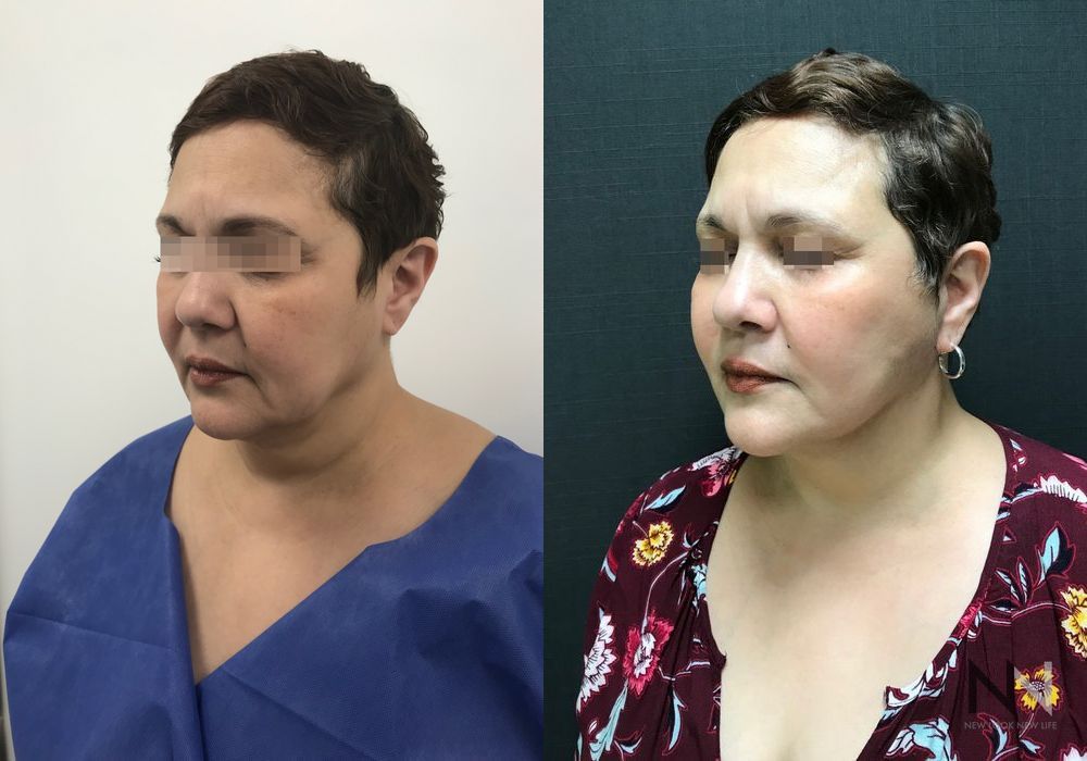 Facelift - Thumbnail 3