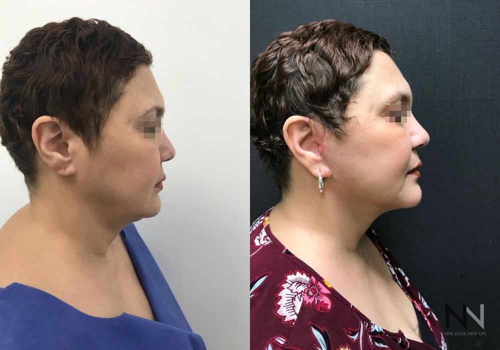 Facelift - Case 1637