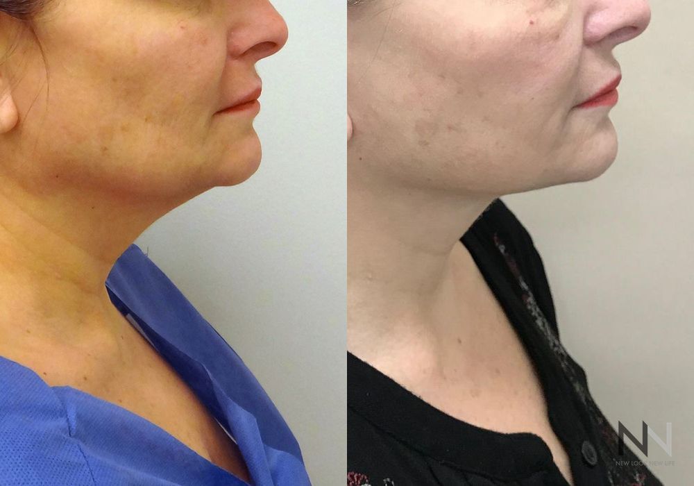 Facelift - Thumbnail 2