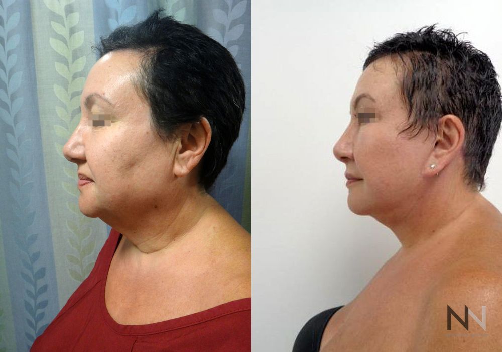 Facelift - Case 1638