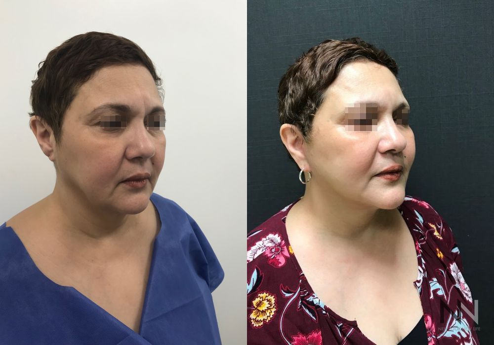 Facelift - Thumbnail 4