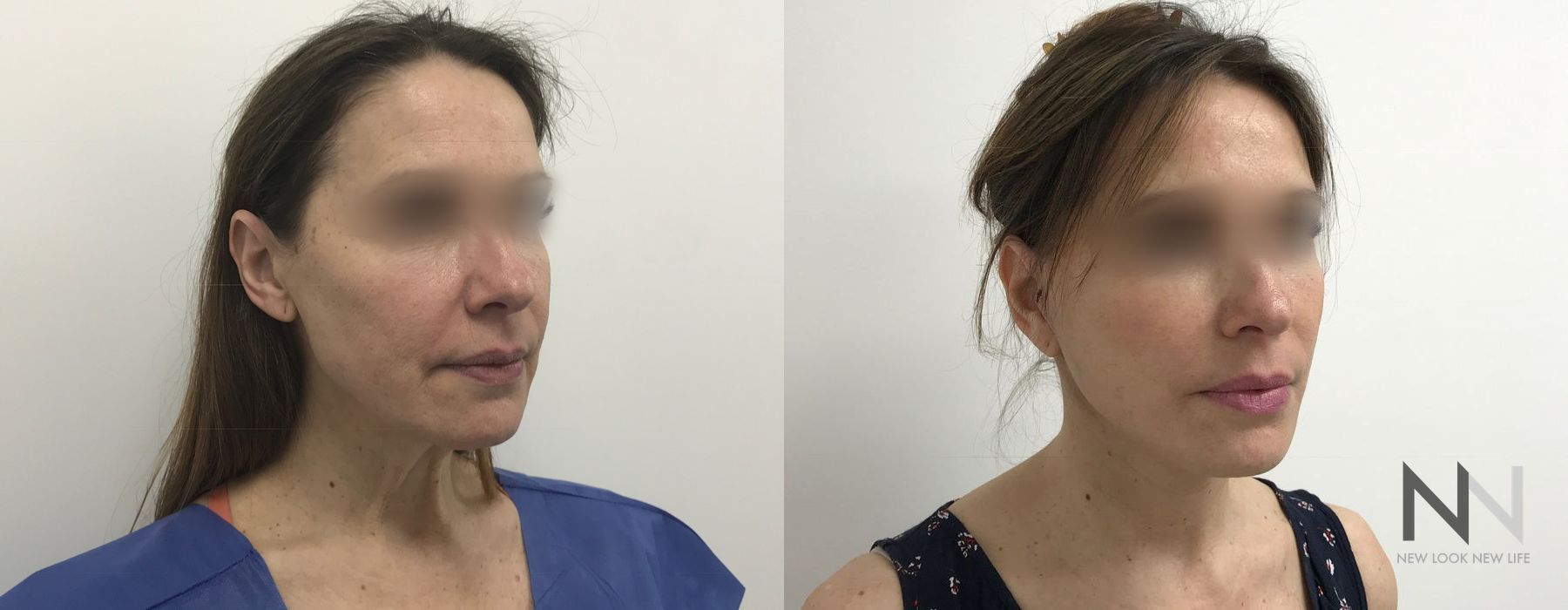 Facelift - Thumbnail 2