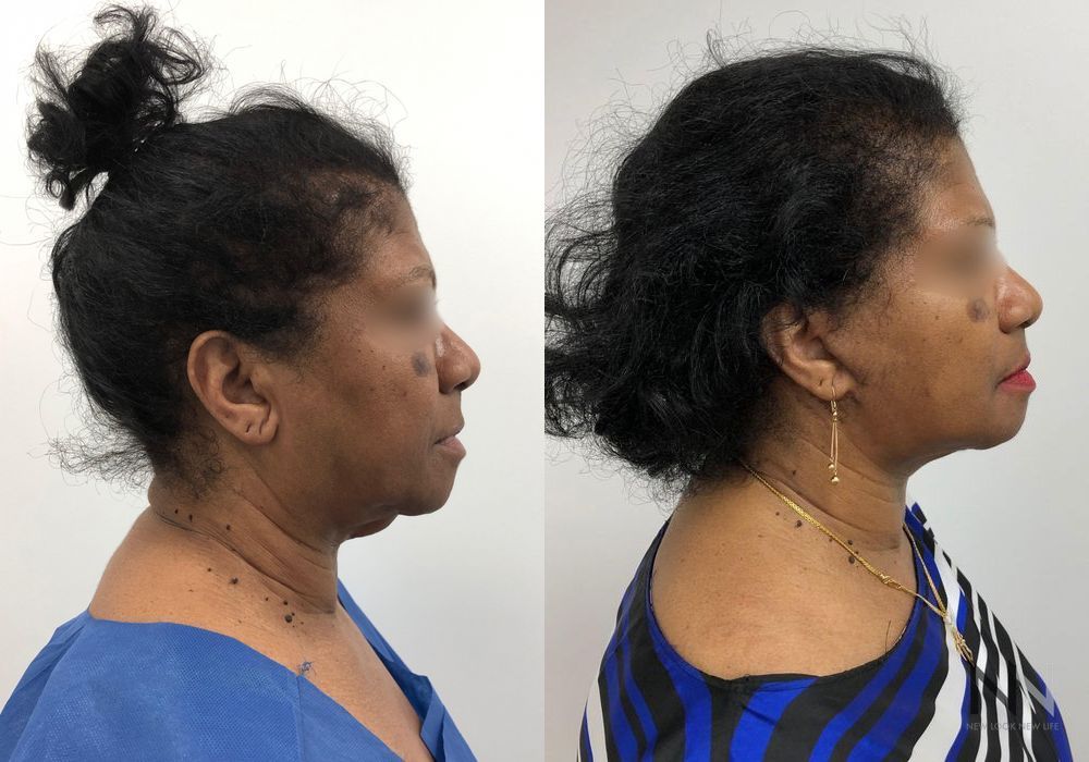 Facelift - Thumbnail 4