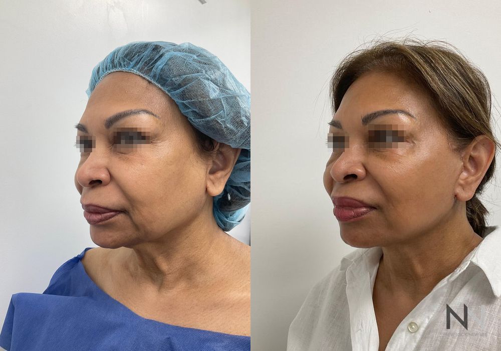 Facelift - Thumbnail 2