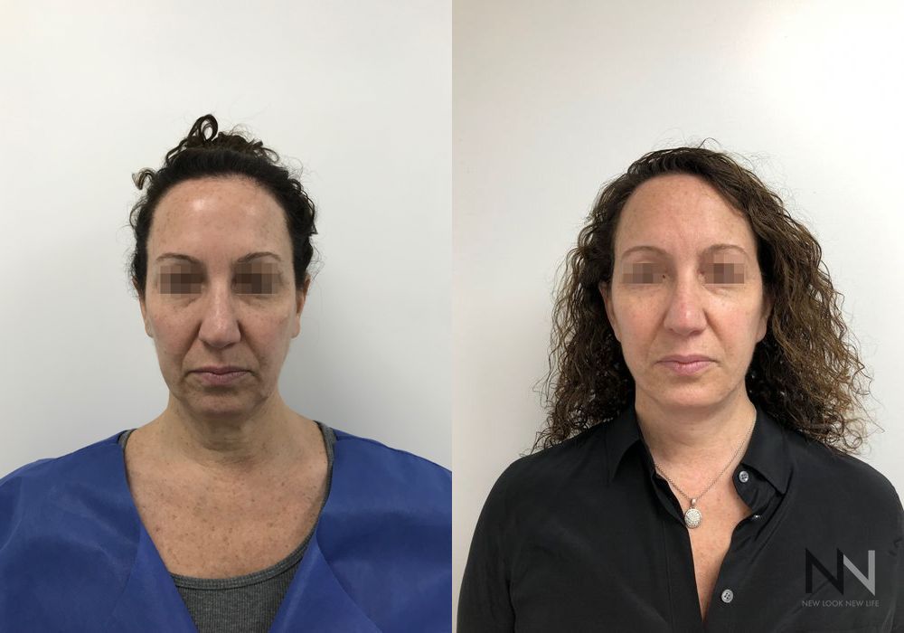 Facelift - Case 2164