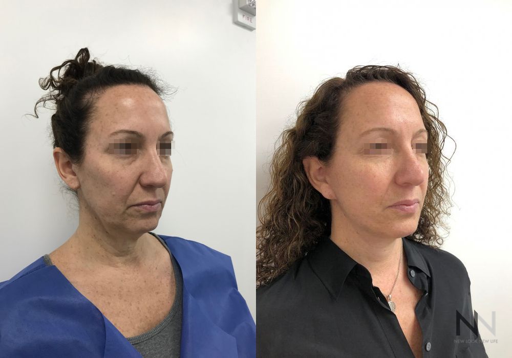 Facelift - Thumbnail 4